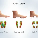 Flat Feet vs. High Arches: What You Need to Know