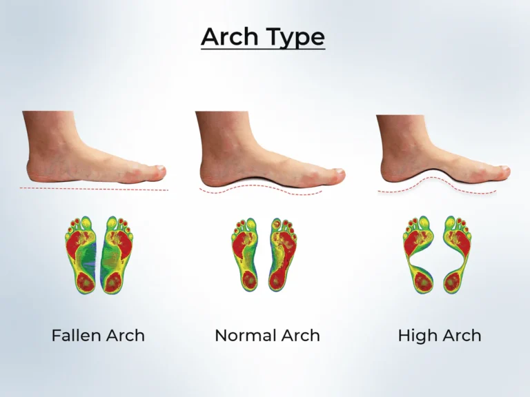 Flat Feet vs. High Arches: What You Need to Know