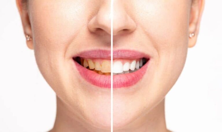 The Truth About Teeth Whitening: Is It Safe and Effective?