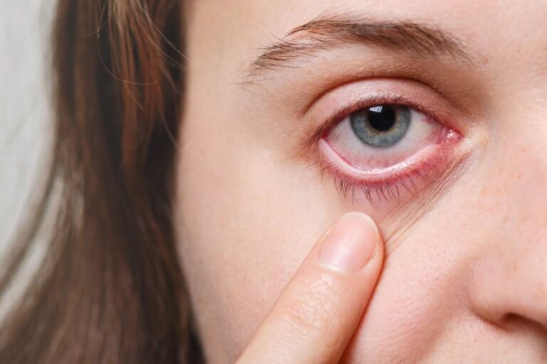 Eye Infections: Types, Causes, and Prevention Tips